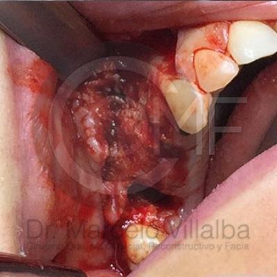 Comunicacion Seno Maxilar 2