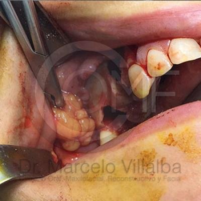 Comunicacion Seno Maxilar 4