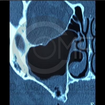 Comunicacion Seno Maxilar 12