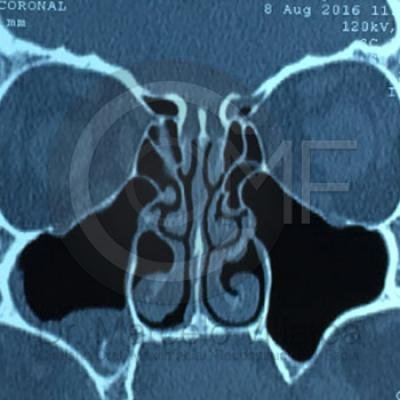 Comunicacion Seno Maxilar 16