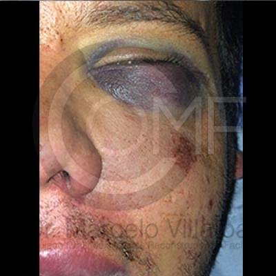 013 Fractura De Malar19