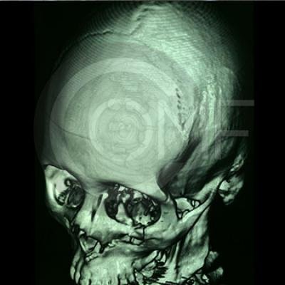 013 Fractura De Malar