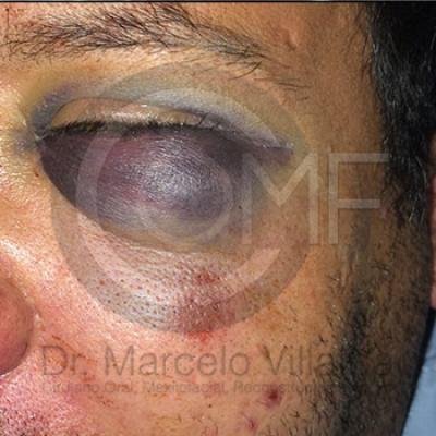 014 Fractura De Malar20