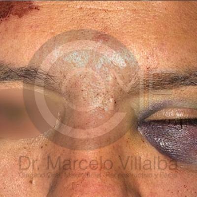 015 Fractura De Malar21