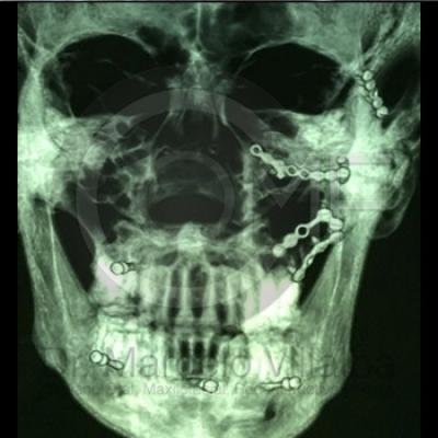 Fractura De Malar14 Post