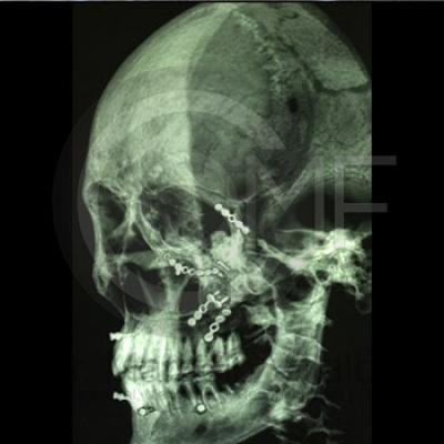 Fractura De Malar2 Post