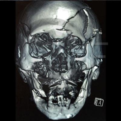 Fractura Facial5