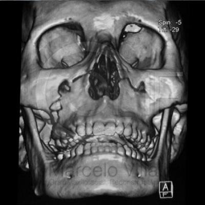 Fractura Lefort I 1