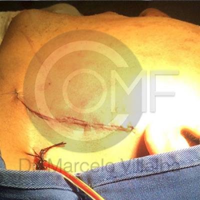 Fractura Mandibular03