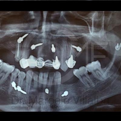 Fractura Mandibular04a