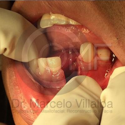 Fractura Mandibular13
